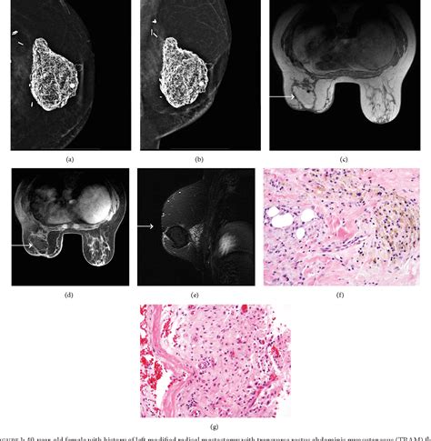 7%) and more biopsies were performed based on suspicious radiological findings (3. . Fat necrosis after breast reconstruction